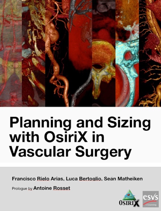 Planning and Sizing with OsiriX in Vascular Surgery