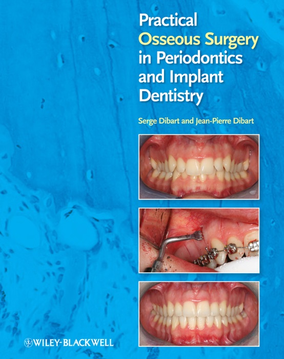 Practical Osseous Surgery in Periodontics and Implant Dentistry