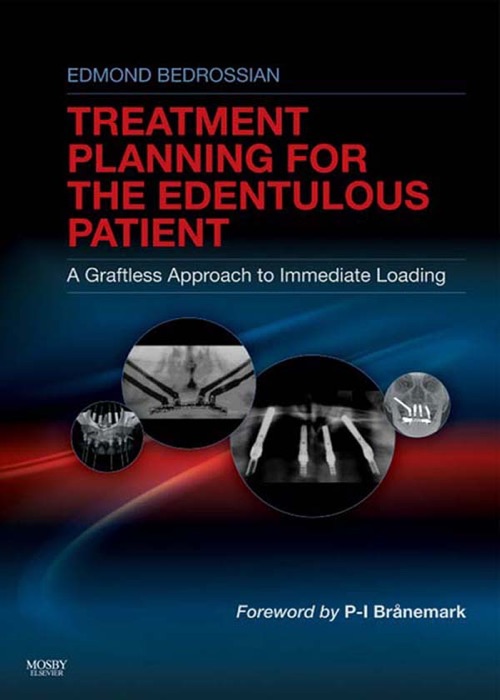 Implant Treatment Planning for the Edentulous Patient - E-Book