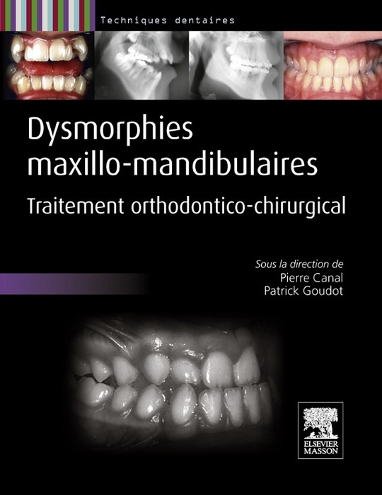 Dysmorphies maxillo-mandibulaires