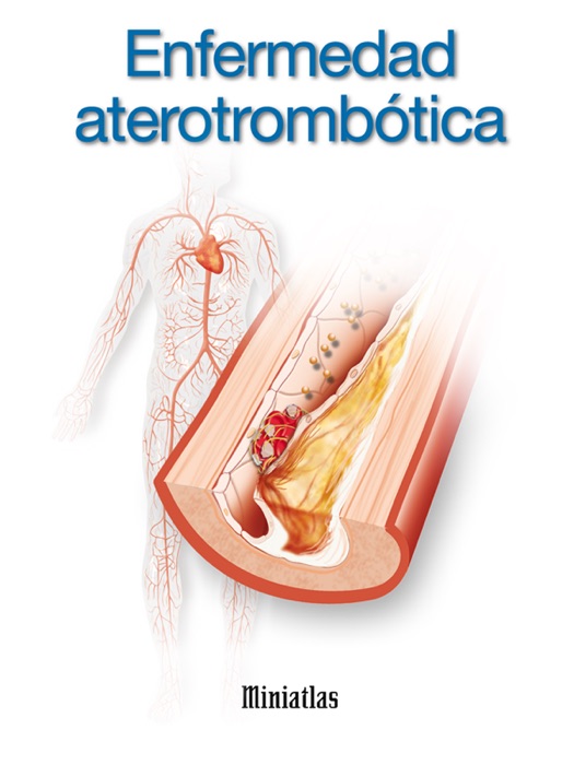 Miniatlas: Enfermedad aterotrombótica