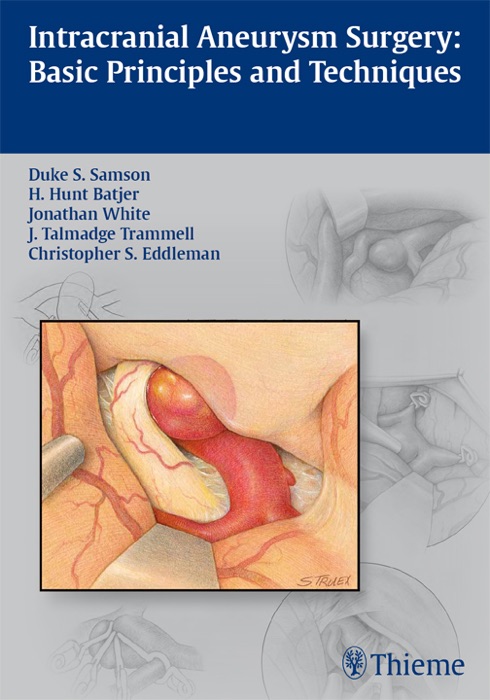 Intracranial Aneurysm Surgery