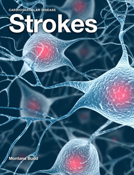 Strokes & Cardiovascular Disease