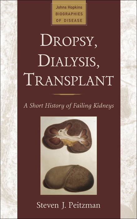 Dropsy, Dialysis, Transplant