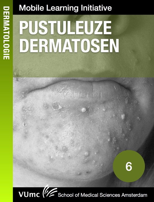 Pustuleuze dermatosen