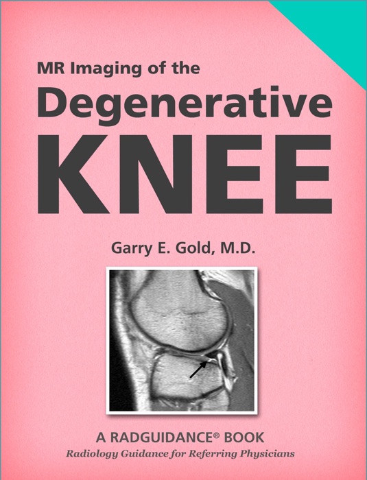 MR Imaging of the Degenerative Knee