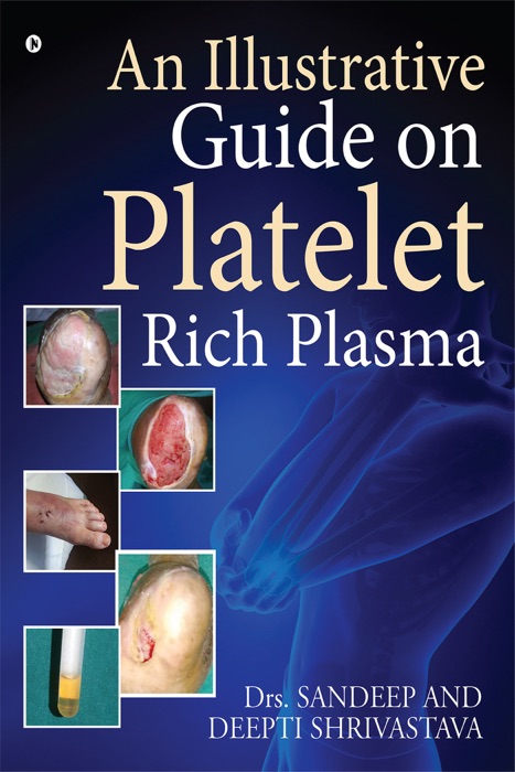 An Illustrative Guide on Platelet Rich Plasma