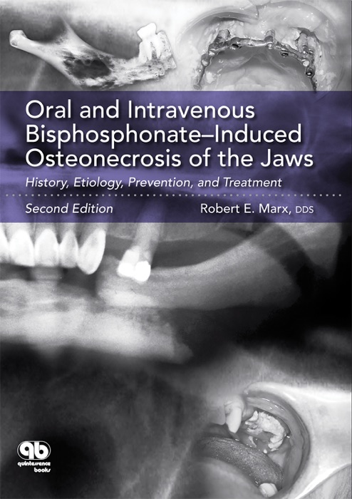 Oral and Intravenous Bisphosphonate–Induced Osteonecrosis of the Jaws
