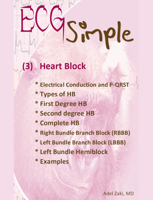 ECG Simple (3) Heart Block