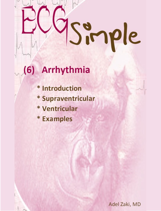 ECG Simple (6) Arrhythmia