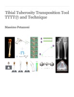 TTTT - Tibial Tuberosity Transposition Tool and Technique