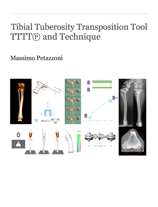 TTTT - Tibial Tuberosity Transposition Tool and Technique