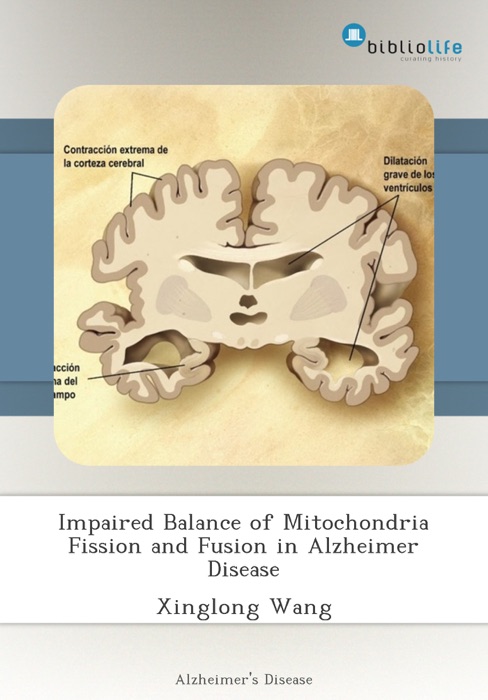 Impaired Balance of Mitochondria Fission and Fusion in Alzheimer Disease