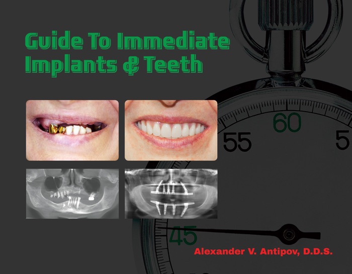 Guide To Immediate Implants And Teeth