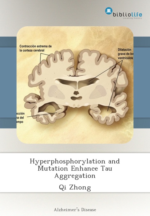 Hyperphosphorylation and Mutation Enhance Tau Aggregation