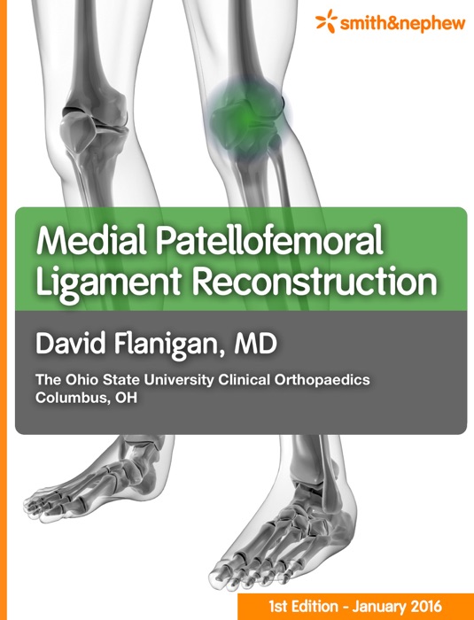Medial Patellofemoral Ligament Reconstruction