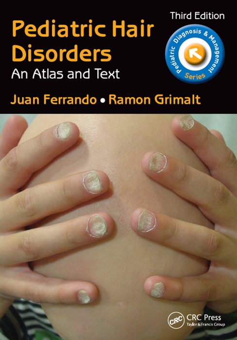 Pediatric Hair Disorders