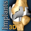 Implants 3D