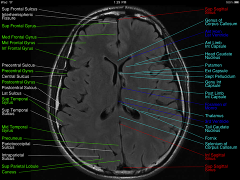 Brain MRI Atlas screenshot 4