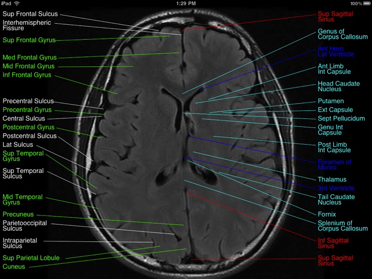 Brain MRI Atlas screenshot-3