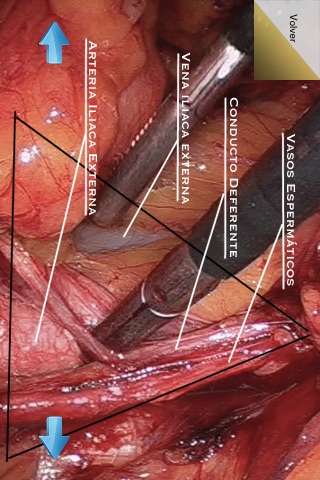 Hernia Inguinal -- Cirugía Laparoscópica de la Hernia Inguinal Lite