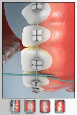 Dr. Boutin Orthodontics: CavityFree 3D screenshot-4
