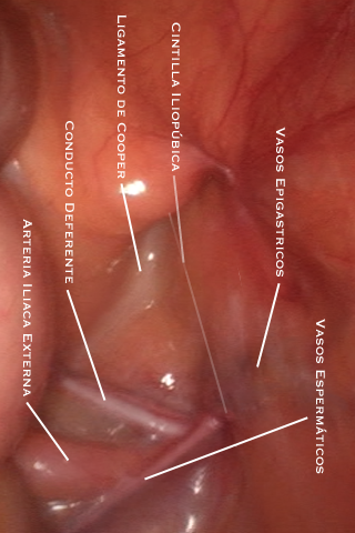 Hernia Inguinal -- Cirugía Laparoscópica de la Hernia Inguinal Lite screenshot 3