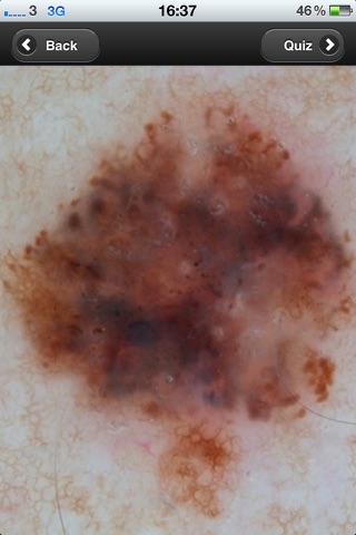 Virtual Dermatoscope screenshot 2