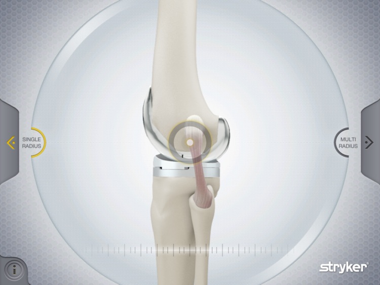 Stryker Get Around Knee