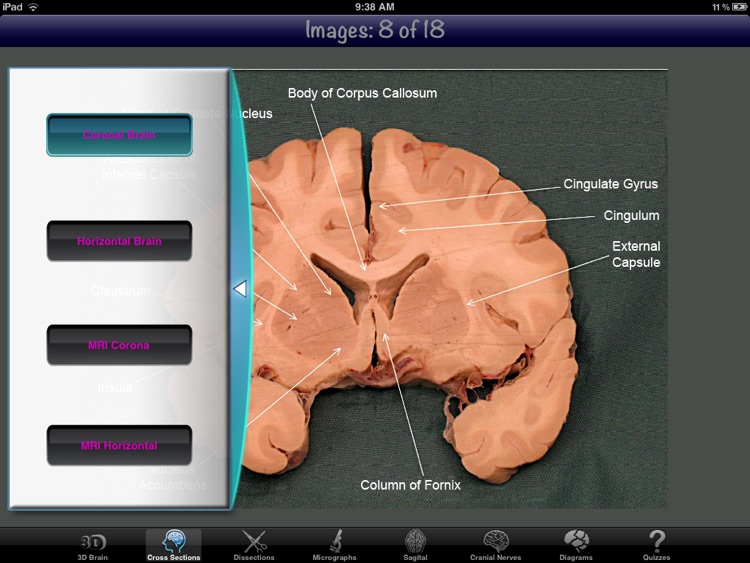 Anatomy Of The Brain 2D/3D screenshot-4