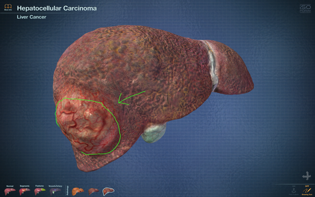 Liver Viewer(圖4)-速報App