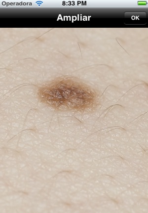 Melanoma iABCD rule(圖3)-速報App