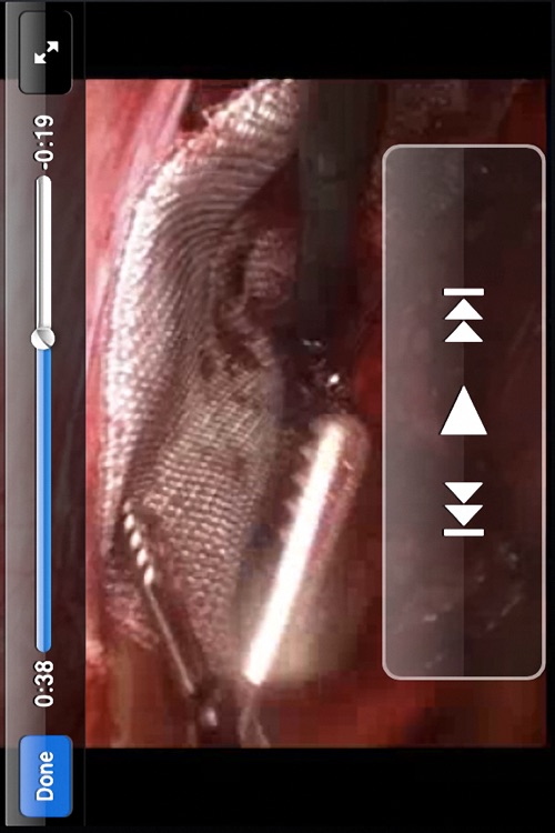 Laparoscopic Inguinal Hernia Repair screenshot-3