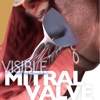 Visible Mitral