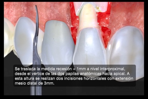 Periodontal Advanced Surgery By Mariano Sanz screenshot 4