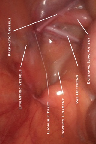 Laparoscopic Inguinal Hernia Repair screenshot 3