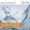 BurnCase 3D 2.0 Donate