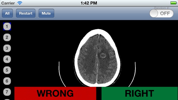 Neuroradiology Flashcards