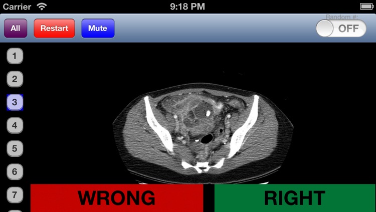 Pediatric Radiology Flashcards