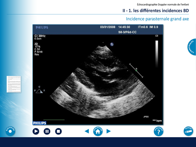 Echocardiographie chez l'enfant(圖2)-速報App