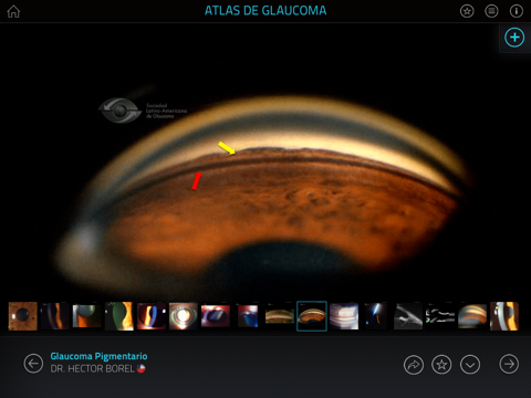 Atlas de Glaucoma screenshot 4