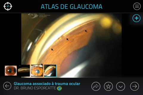 Atlas de Glaucoma para iPhone screenshot 3