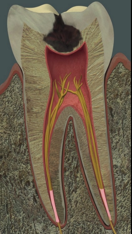 Dental Pain