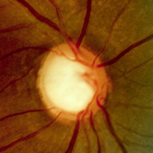 Glaucoma Calc