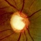 Glaucoma Calc can be used to estimate the risk of a patient with ocular hypertension developing glaucoma within 5 years