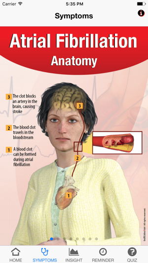 Signs & Symptoms Atrial Fibrillation(圖2)-速報App