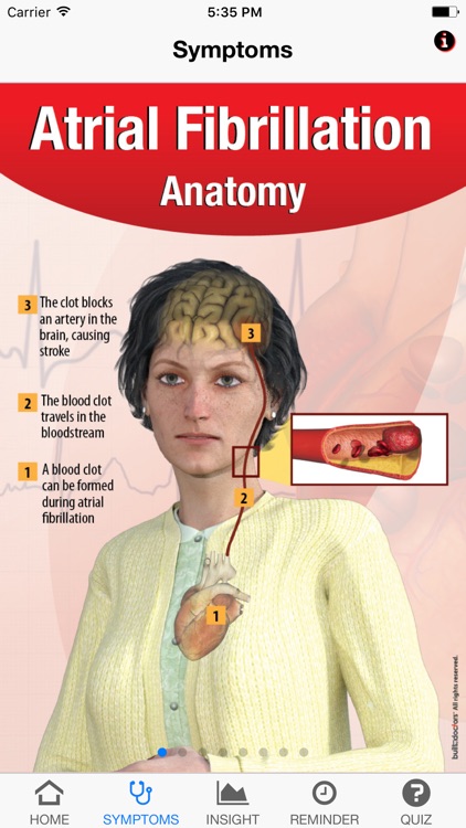 Signs & Symptoms Atrial Fibrillation