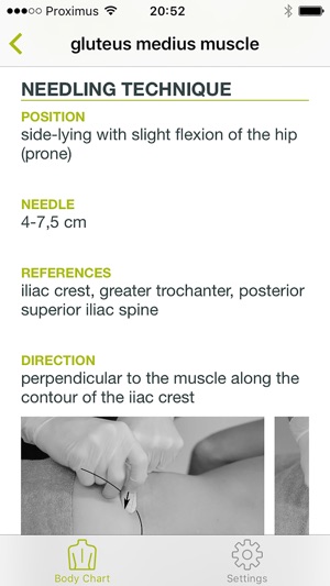 Dry Needling Guide(圖3)-速報App