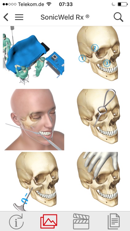 KLS Martin CMF Implants screenshot-3