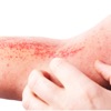 Managing Atopic Dermatitis